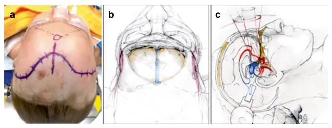 对于中线入路，患者取仰卧位，在发际线后方标记弧形皮肤切口（a）。开颅以三角形方式在双侧对称进行，并向下延伸至接近眶顶（b）。通过额叶纵裂可抵达整个视交叉-下丘脑区域及Willis环（c）。