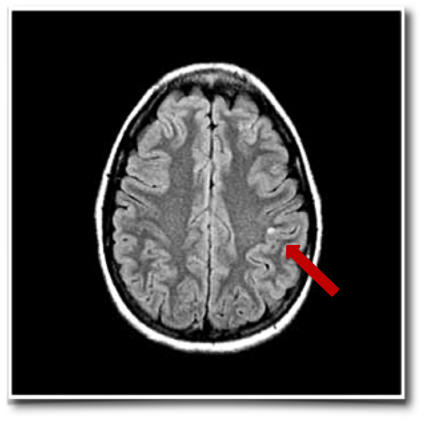 顶叶一处微小囊性病变