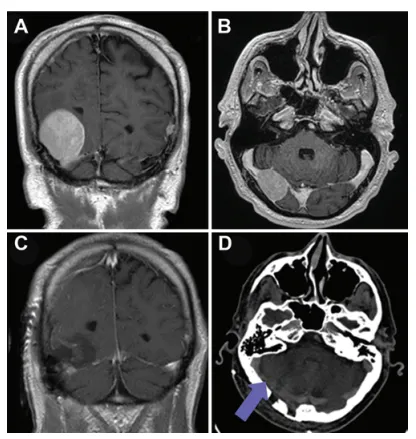 病例1，术前冠状位（A）与轴位（B）增强T1加权磁共振图像显示右侧小脑幕区一类圆形、均匀强化的轴外病变侵犯横窦。术后冠状位增强T1加权磁共振图像（C）显示肿瘤大体全切除。术后轴位脑CT静脉成像（D）显示右侧横窦部分血栓形成（箭头所示）。