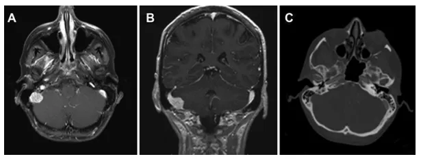 病例2，术前轴位（A）与冠状位（B）增强T1加权磁共振图像显示右侧后颅窝一类圆形、均匀强化的轴外病变，并延伸至乙状窦内。术前轴位脑CT血管成像（C）显示右侧乙状窦因肿瘤压迫侵犯致部分闭塞。