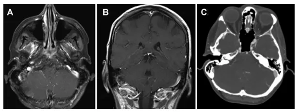 病例2，术后轴位（A）与冠状位（B）增强T1加权磁共振图像显示右侧后颅窝脑膜瘤已实现大体全切除。术后轴位脑CT血管成像（C）显示右侧乙状窦通畅。