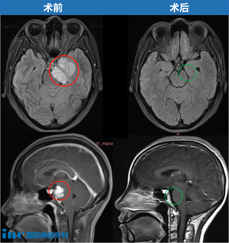 “你这不像是做了开颅手术吧？”我36岁，大脑4.5cm脑膜瘤切除，却彷佛没剃一