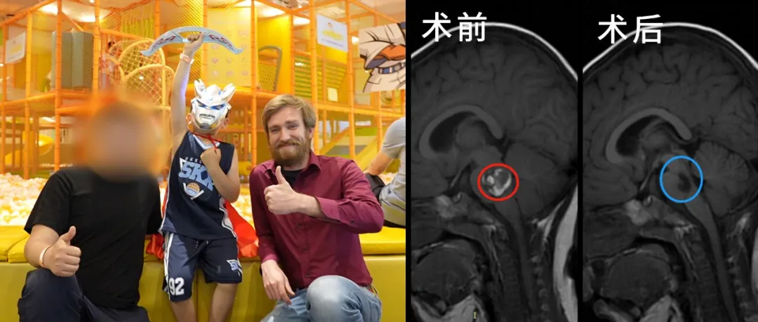 “只是电视看多了？”——1岁半儿子出现斜视，没想到竟是“脑瘤”