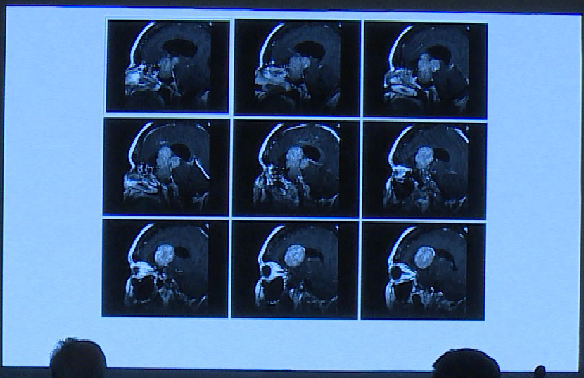 术前影像显示肿瘤巨大