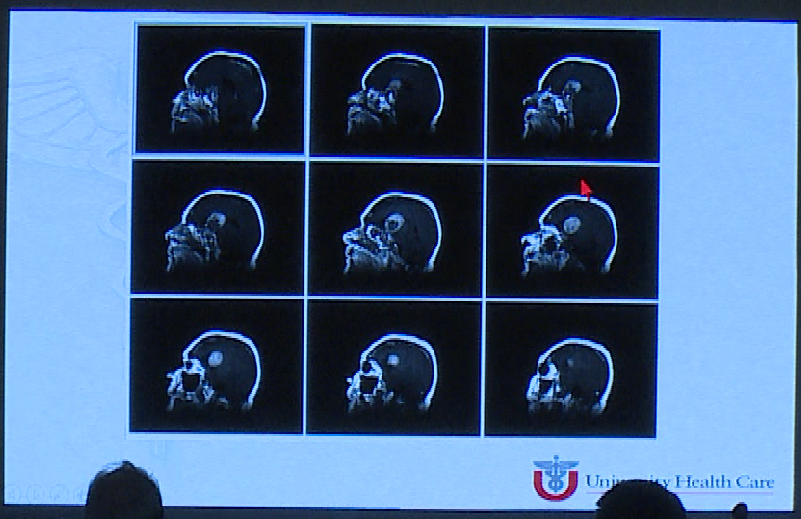 术后影像，肿瘤体积明显缩小