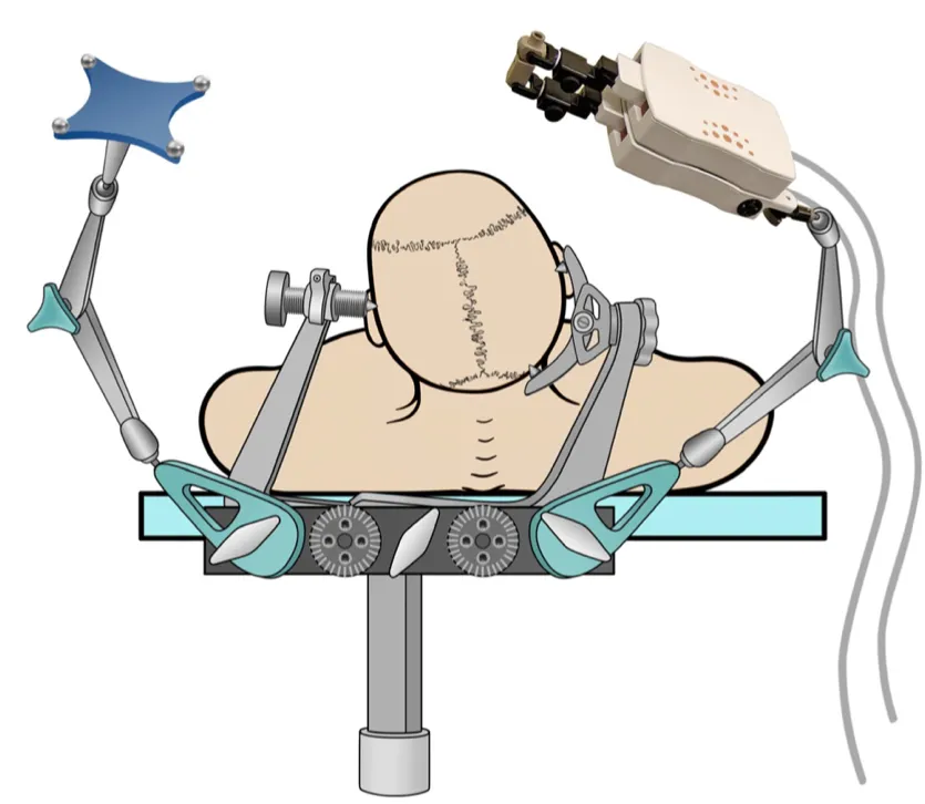在神经导航的帮助下用于植入深度电极的微型机器人设备的插图，头部固定在标准头部夹中，并带有导航参考和通过适配器连接的机器人