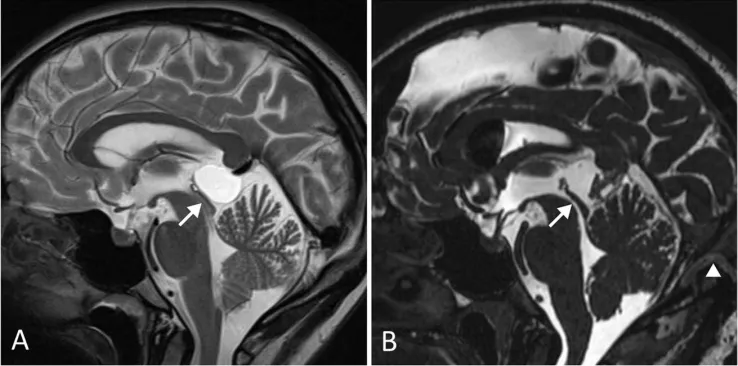 术前（A）可见松果体囊肿导致Sylvian大脑导水管狭窄（箭头），无脑积水表现。该患者表现为长期且逐渐加重的头痛。术后（B）囊肿完全切除，大脑中水管通畅，患者症状完全缓解。