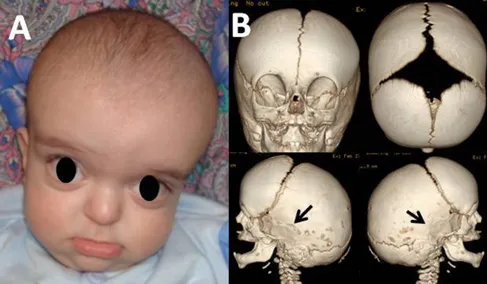 图1.患儿就诊时的照片(A)。经计算机断层扫描(CT)三维重建显示，颅骨穹窿处的缝合线呈广泛开放状态，而顶骨缝以及顶枕-乳突缝则呈双侧融合状态(箭头)(B)。