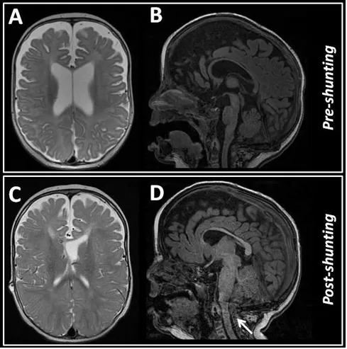 图2.初次就诊时进行的脑磁共振成像(MRI)显示脑室扩张，但无明显迹象表明脑脊液循环受阻(B、C)。两个月后进行的MRI检查排除了分流器功能异常的情况，但显示后颅窝空间拥挤，伴有Chiari型畸形(C、D)，箭头所示。