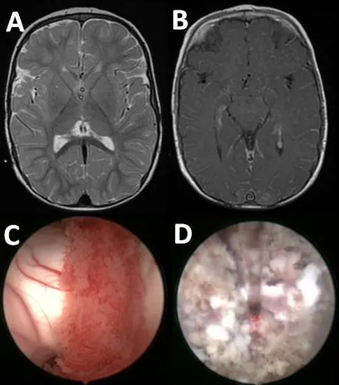 图3.脑部磁共振成像(MRI)结果排除了影响脉络丛的病理状况(A)、(B)。脉络丛的内窥镜图像，包括使用前(C)及凝血操作期间(D)的情况。