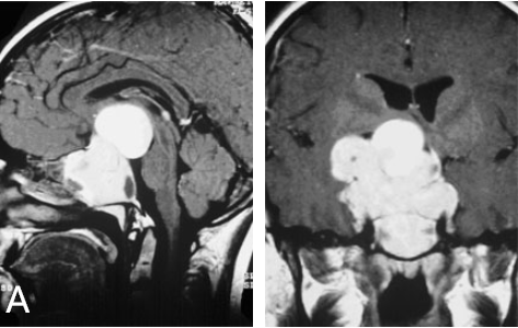 同为垂体瘤，为何有人吃药就能消失，有人却需要手术切除？