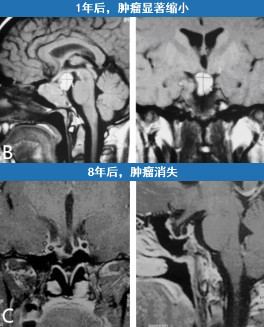 1年后，肿瘤显著缩小  8年后，肿瘤消失