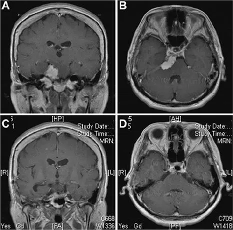 图5：案例1。Kawase入路手术切除肿瘤。术前MRI冠状位（A）和轴位（B）增强图像提示岩斜区一均匀强化的肿瘤，起源于岩尖，附着在小脑幕上。肿瘤推挤脑干，侵犯海绵窦。术后MRI（C和D）显示肿瘤全切。