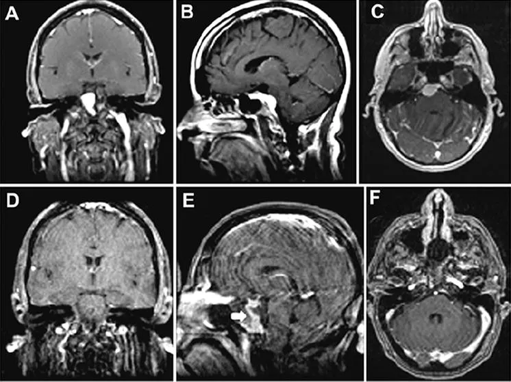 图6：案例2。增强T1加权磁共振成像获得的一个病人的岩斜脑膜瘤，通过EEA治疗。术前冠状位（A）、矢状位（B）和轴位（C）图像显示起源于上斜坡的岩斜脑膜瘤。肿瘤均匀强化，脑干受压，无海绵窦侵犯。术后冠状面（D）、矢状面（E）和轴向（F）MR图像显示肿瘤完全切除。E：图中的白色箭头示增强的重建的鼻中隔，提示其血供保留。
