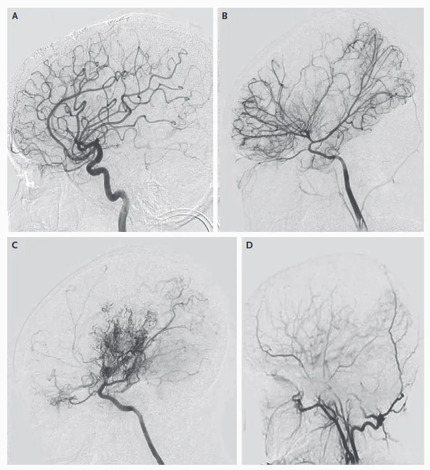烟雾病的血管造影结果