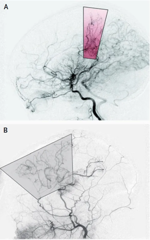 间接搭桥术 （如EDAS/EMS/骨膜贴敷术）