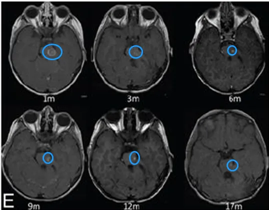 在第1、3、6、9、12和17个月随访的轴向T1加权对比增强MR图像显示，肿瘤的体积逐渐缩小。