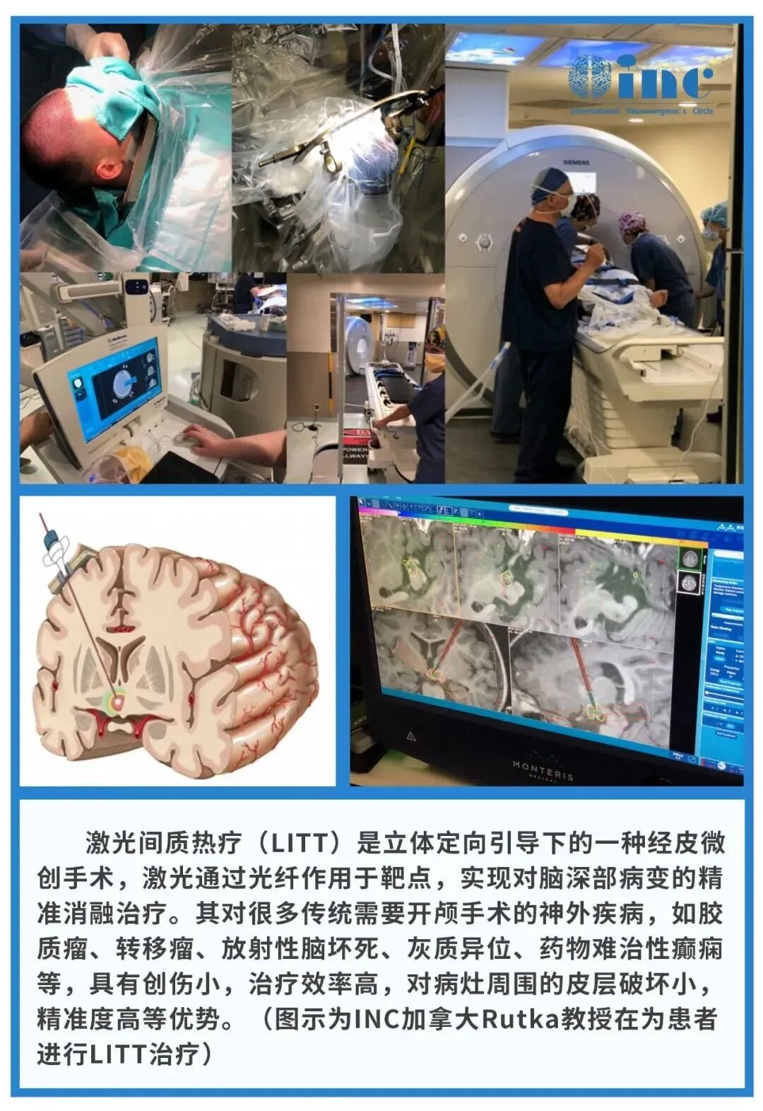 激光间质热疗（LITT）是一种在立体定向引导下进行的经皮微创手术。激光能量通过光纤传导至靶点，实现对脑深部病变的精准消融治疗。该技术对于许多传统上需要开颅手术的神经外科疾病，如胶质瘤、转移瘤、放射性脑坏死、灰质异位、药物难治性癫痫等，具有创伤小、治疗效率高、对病灶周围皮层破坏小以及精准度高等优势。（图示为INC加拿大Rutka教授正在为患者实施LITT治疗）