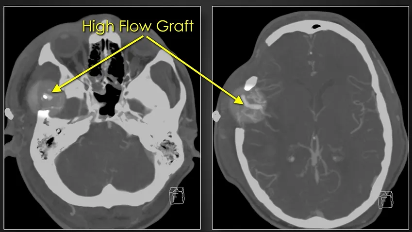 High Flow Graft