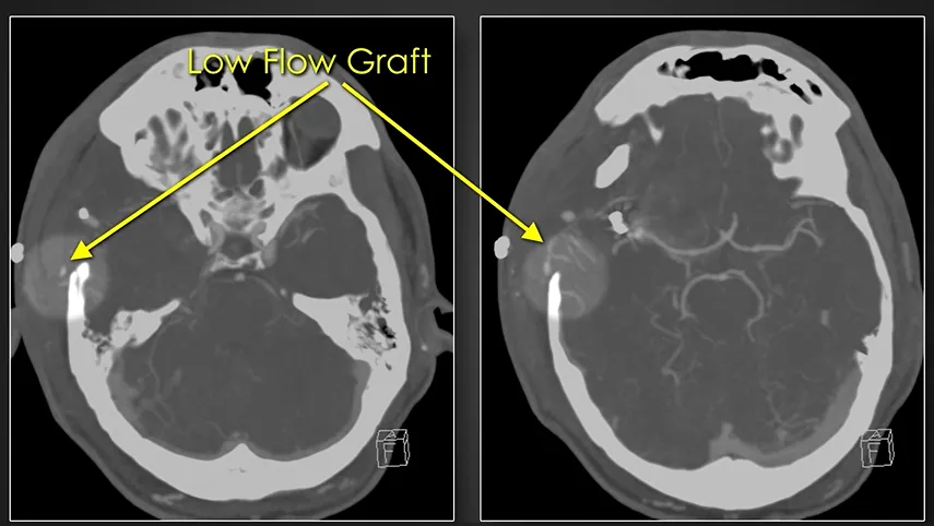Low Flow Graft