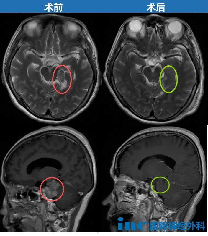 患者自述 |“手术风险巨大、也不能再放疗！”脑膜瘤复发却求医无门，她该怎
