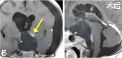 早期MRI疑似有少量残留