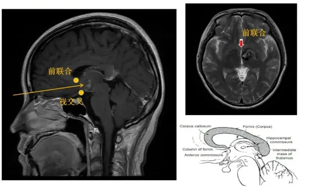 巴教授还将前联合作为关键解剖标记，精准定位肿瘤位置——它正位于前联合后方。