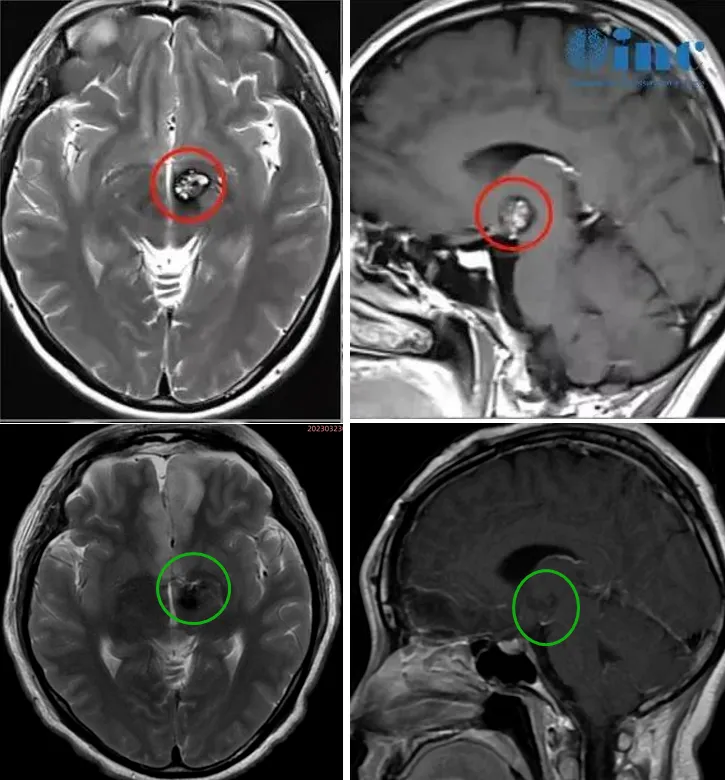 手术顺利完成：病灶被完全切除，患者的神经功能也得到了完整保护。