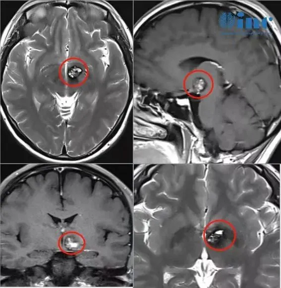 左侧基底节-丘脑区占位，考虑海绵状血管瘤，并瘤内出血。