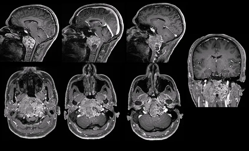 26岁男子脑内惊现10厘米巨瘤！从脖子疼到吞咽困难，一颗“橙子”压住生命中