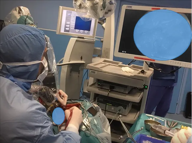 显微镜下暴露肿瘤并进行切除，然后使用神经内镜辅助探查肿瘤，备行内镜手术。