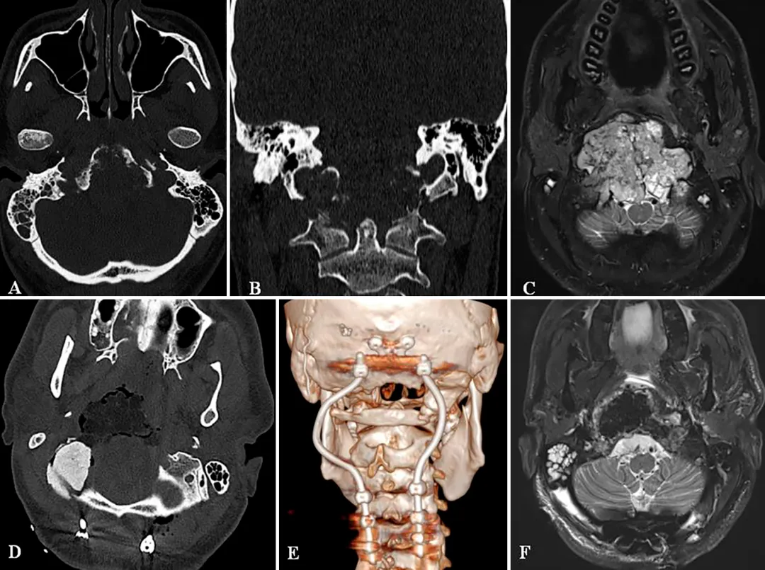 A和B:术前CT扫描显示颅颈交接区脊索瘤，侵犯斜坡-枕髁并呈溶骨性破坏。  C:术前MR显示肿瘤巨大延伸，并浸润长入硬膜内的脑实质。  D:术后CT显示PMMA枕髁重建稳定良好。  E:术后三维CT显示 C0-C3-C4-C5枕颈融合稳定，与根钉弯曲有利于PBRT治疗。  F:术后MR显示全切肿瘤和脑干延髓占位压迫得到解除。