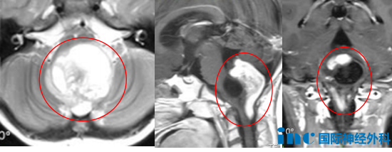 6岁女孩游泳呛水后昏迷，抢救脱险后竟查出巨大脑干胶质瘤