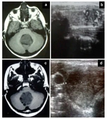 图1 a–c 我们两位患者的术前T1加权MRI图像，显示延伸至第四脑室的中线占位。b–d 术前甲状腺超声检查，显示两位患者右叶均存在低回声肿块。