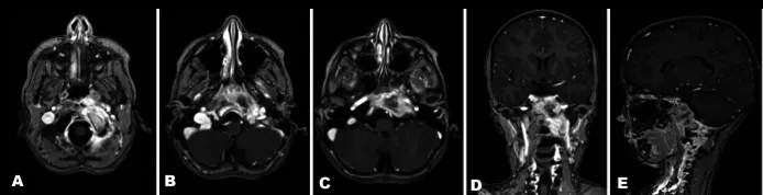 术前MRI，左侧岩骨及斜坡存在强化病灶，注意观察相邻肌肉的受侵情况