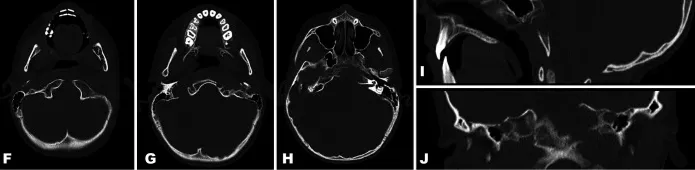 术前CT：左侧岩骨及斜坡骨质存在骨溶解性病灶