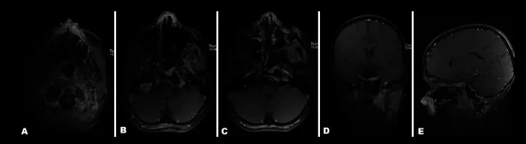术后1天，骨肿瘤部分几乎全部切除