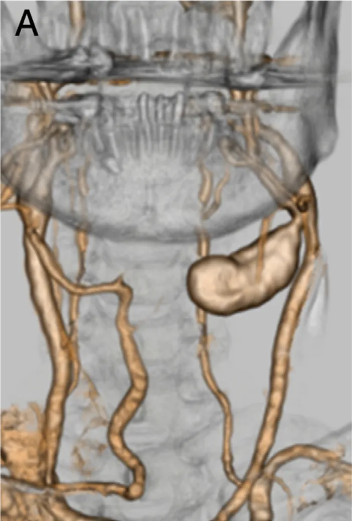 三维CT血管造影显示左颈总动脉瘤样病变