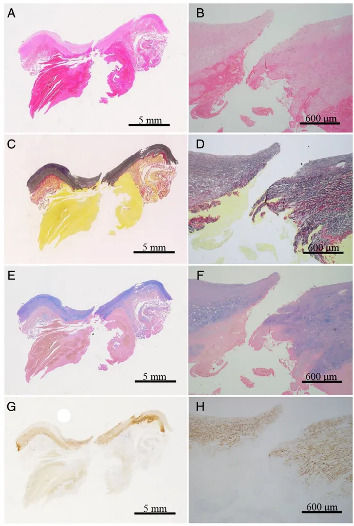 破裂动脉瘤病变连续纵切面的病理学视图  显示了涉及内膜、中膜和外膜的破裂点