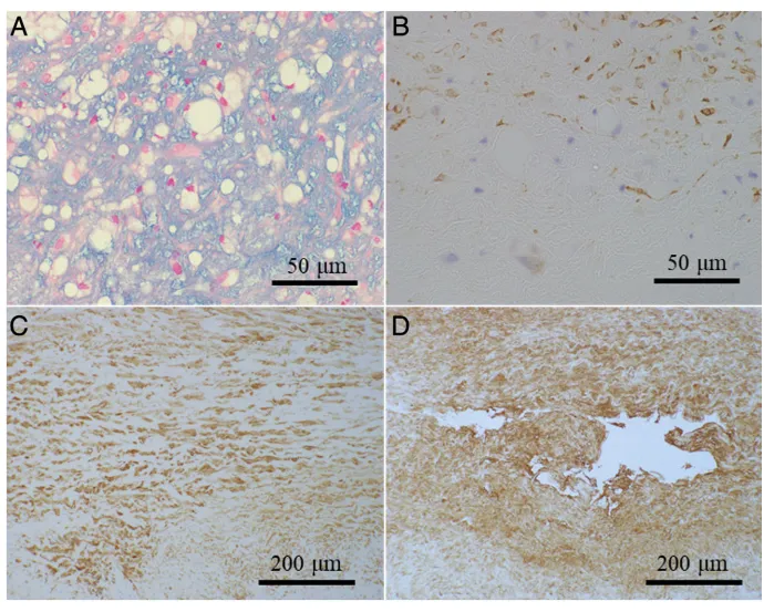 假性动脉瘤破裂点切片。