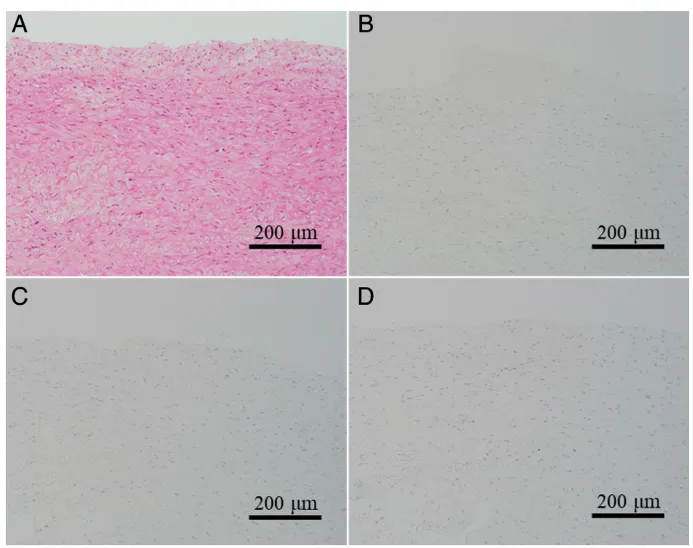假性动脉瘤壁破裂点附近非破裂区域的显微照片。