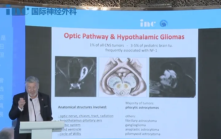 视路-下丘脑胶质瘤的治疗挑战何在？