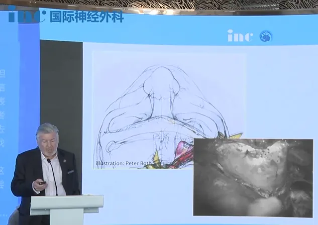 手术入路及经典案例分享