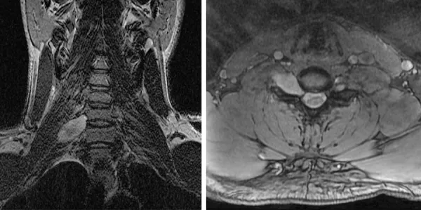 颈椎磁共振成像显示髓内硬膜下、髓外肿块，位于右侧C6-C7神经孔中心并沿C7神经根延伸（冠状位T2加权，左图；轴位T1加权增强，右图）。