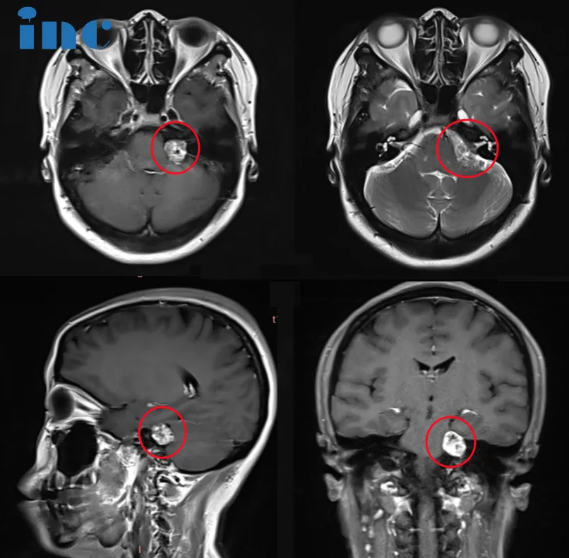左侧听神经瘤