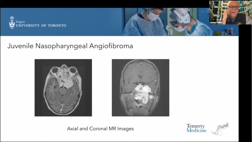 那天从鼻子里取出肿瘤后，医生说还要“填个洞”
