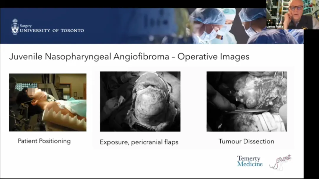 Juvenile Nasopharyngeal Angiofibroma- Operative Images