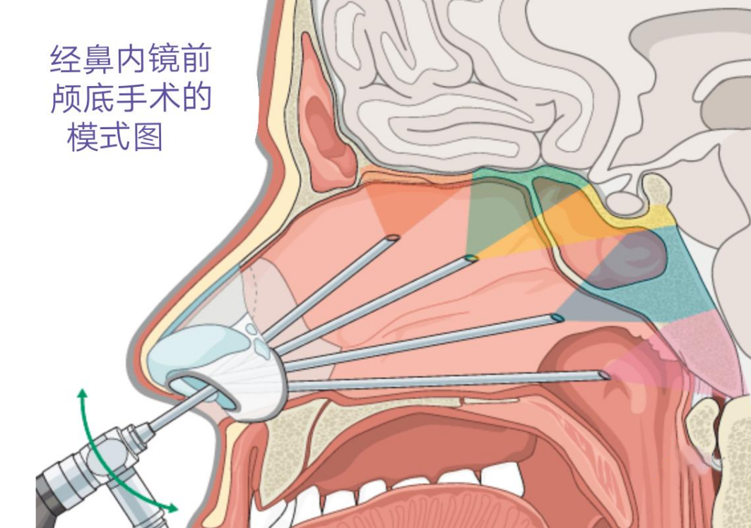 经鼻内镜前颅底手术的模式图