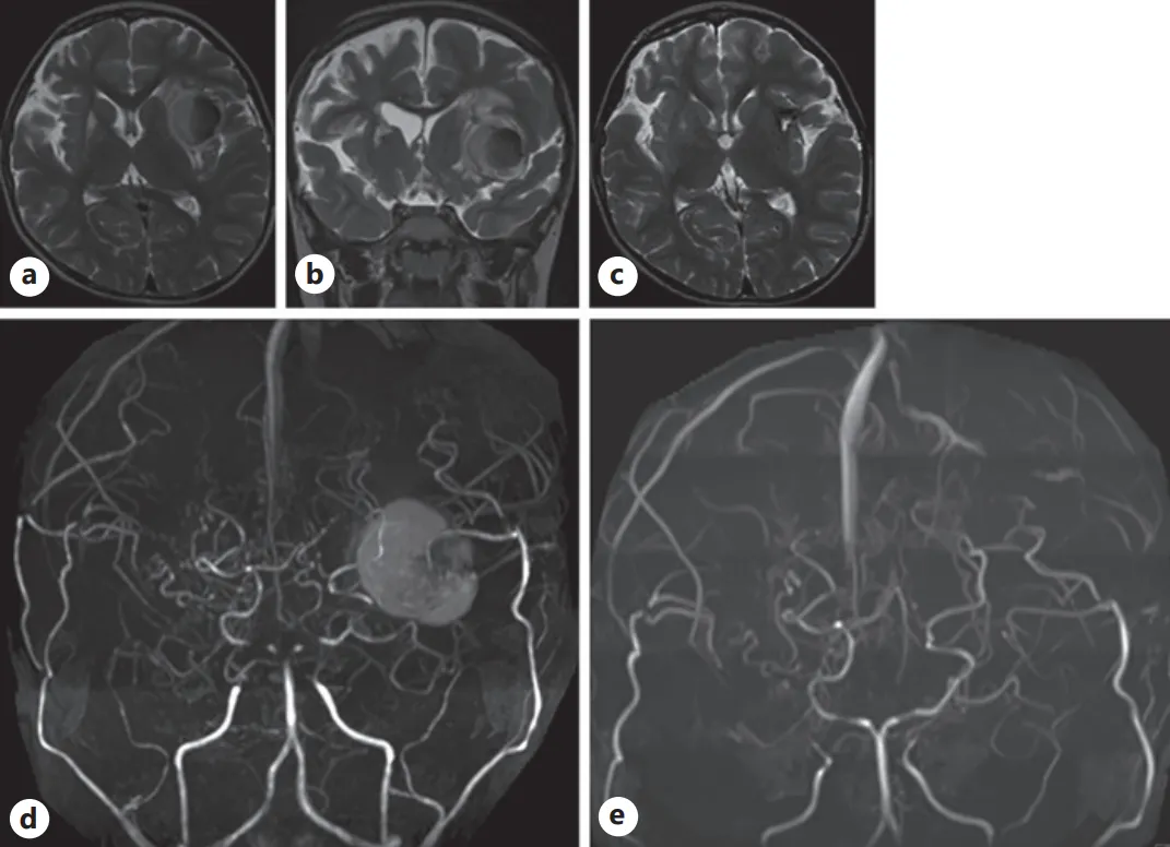 随访轴位（a）与冠状位（b）T2加权磁共振成像（MRI）图像：可见左侧岛叶病灶扩大至两倍以上，周围伴有水肿组织；  （c）术后T2加权MRI显示，原异常病灶已被手术疤痕组织取代；术前（d）与术后（e）磁共振血管造影（MRA）：术前MRA上的较大病灶在术后影像中已完全消失。
