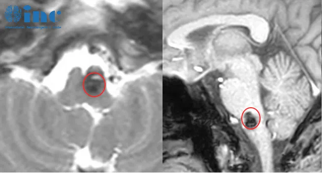 延髓海绵状血管瘤